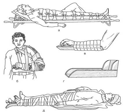 Стандартное средство транспортной иммобилизации. Транспортная и лечебная иммобилизация. Транспортная иммобилизация при переломах. Лубочные шины для иммобилизации. Средства транспортной иммобилизации раненных.