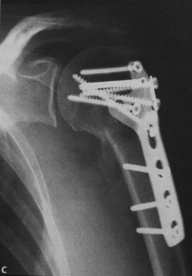 Перелом бугорка плечевой кости. Остеосинтез большого бугорка плечевой кости.