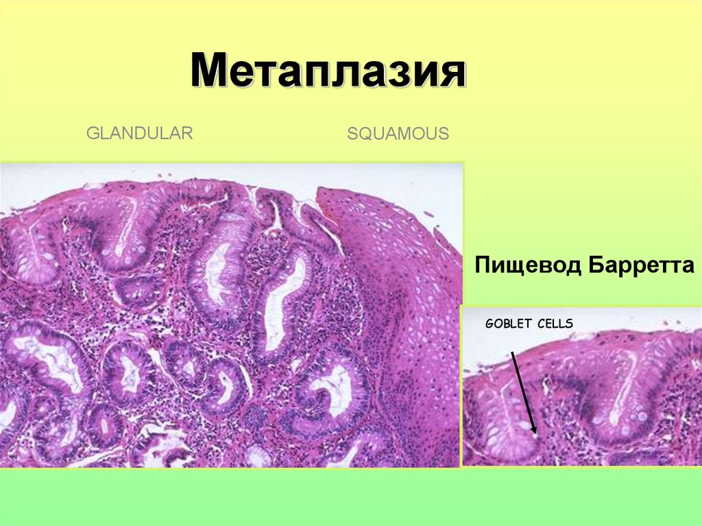 Метаплазия это. Метаплазированный эпителий желудка. Плоскоклеточная метаплазия пищевода.