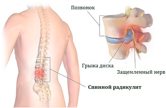 Воспаление позвоночника. Радикулит воспаление Корешков. Воспаление Корешков позвоночника. Радикулит спины.