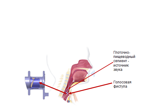 Голосовой протез. Голосовой протез Provox. Голосовой протез Provox Vega. Голосовой протез гортани. Голосовой протез для трахеостомы.