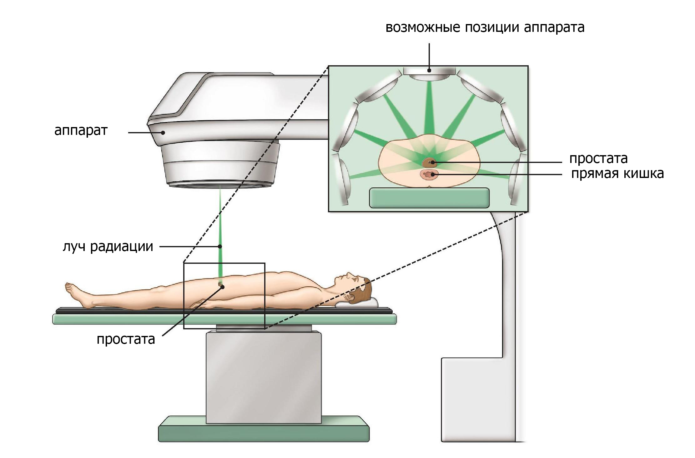 Как проходит лучевая. Гамма излучение лучевая терапия. Короткофокусная лучевая терапия. Лучевое облучение при онкологии.