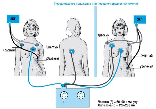 Снять Экг Наложение Электродов Фото