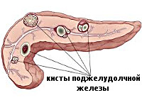 Киста хвост