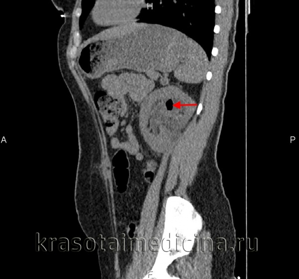 эмфизематозный пиелонефрит