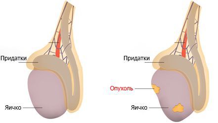 Рак яичка. Новообразование на яичке. Раковая опухоль на мошонке.
