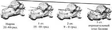Нормальный угол. Пяточная кость угол Беллера. Перелом пяточной кости угол Белера. Угол Беллера пяточной кости. Угол Белера при переломе пяточной.