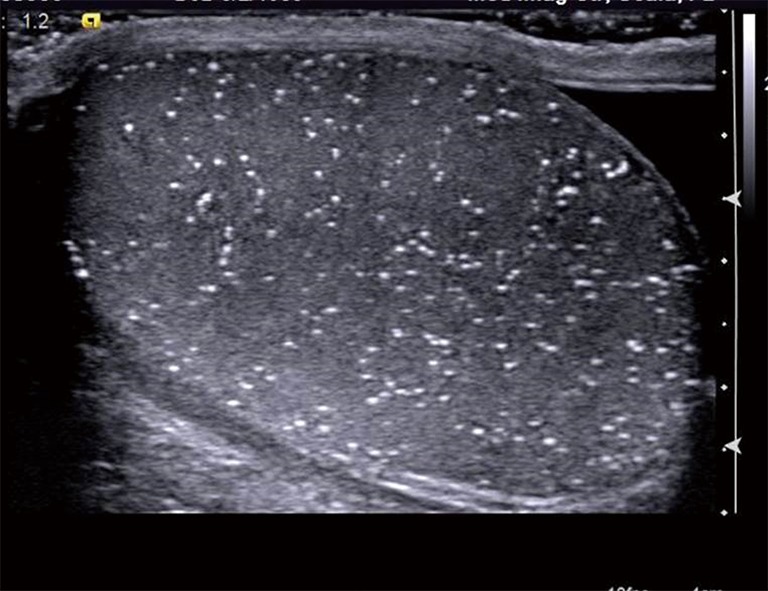 Микрокальцинаты яичек. Тестикулярный микролитиаз УЗИ. Микролитиаз почек УЗИ. Микрокальцинаты яичка УЗИ. Тестикулярный микролитиаз яичек.
