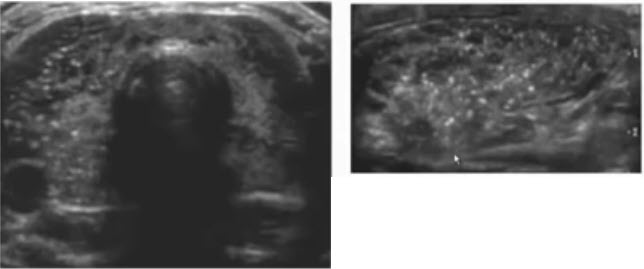 Узи нижних конечностей изранов. Микрокальцинаты УЗИ щитовидной. УЗИ щитовидной железы Изранов. УЗИ лекции Изранова.