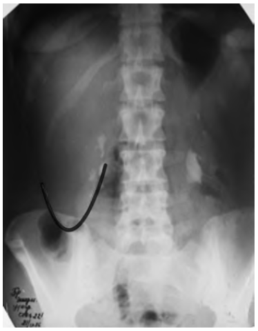 жировой гепатоз развивается при. умеренное увеличение печени. гепатоптоз печени. печень гепатоз жировой гепатоз. гепатоптоз печени.