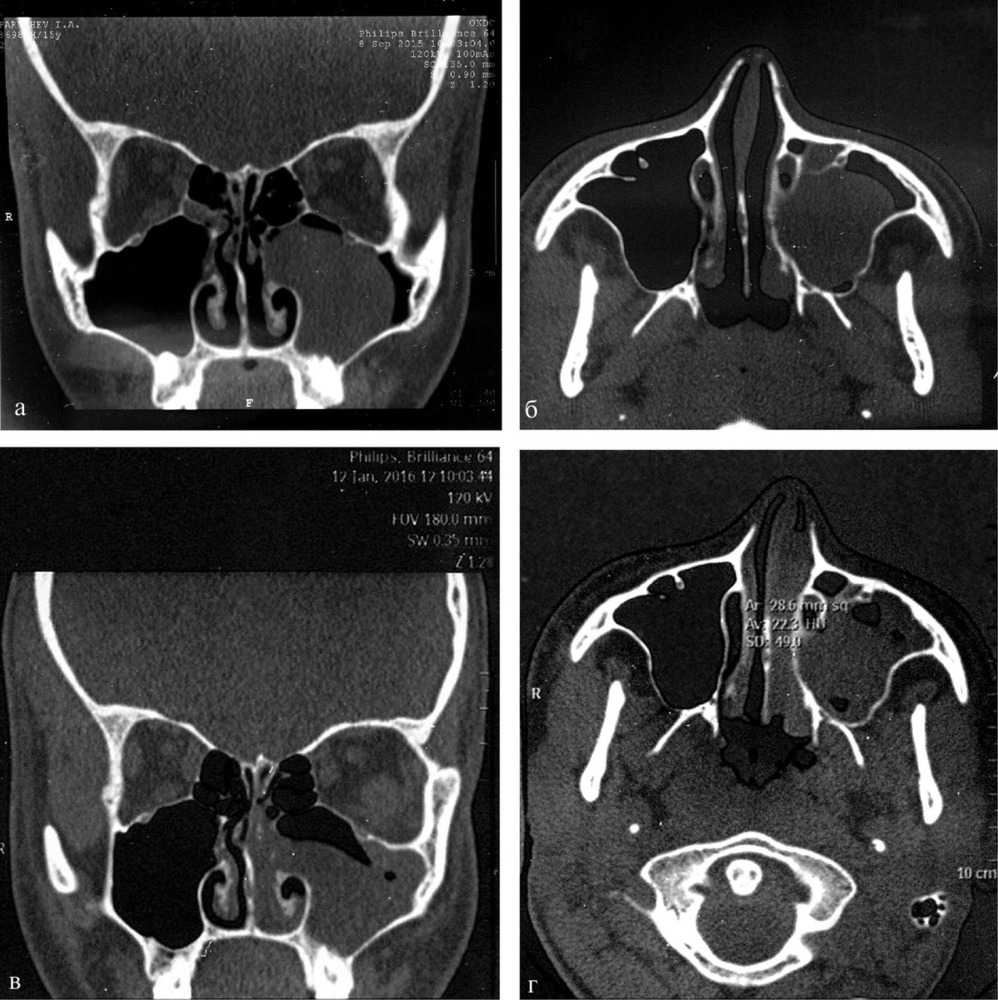 Кт пазух носа. Полип гайморовой пазухи на кт. Полип в верхнечелюстной пазухе носа на кт. Кт остеомиелит гайморовой пазухи.