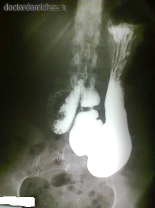 Опущение желудка. Опущение желудка гастроптоз. Гастроптоз рентгеноскопия. Гастроптоз степени рентген. Гастроптоз желудка рентген.