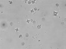 Оксалаты в моче 3. Кристаллы оксалата кальция. Кристаллы оксалата кальция в моче. Оксалат кальция моногидрат. Оксалаты в моче под микроскопом.