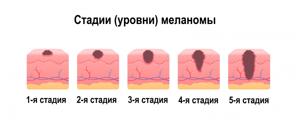 Уровни меланомы по кларку. Поверхностно распространяющаяся меланома.