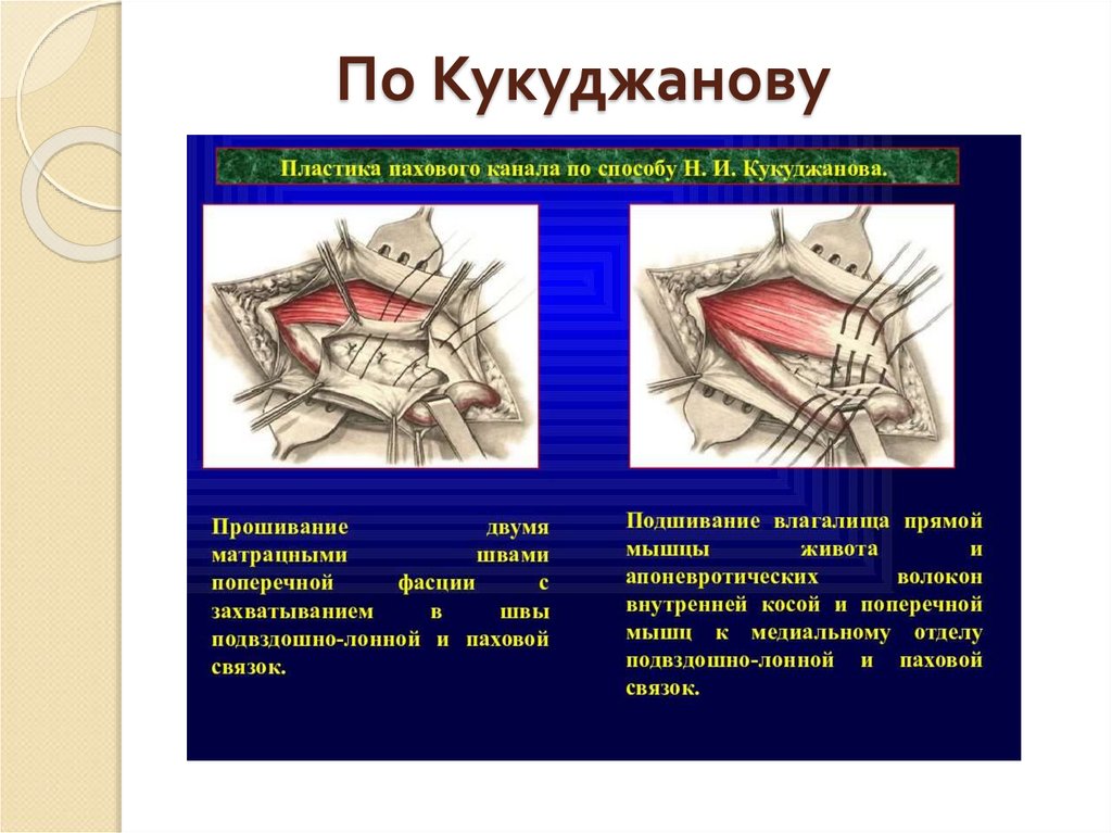 Лечение пахового. Пластика пахового канала Кукуджанова. Грыжесечение по Кукуджанову схема. Пластика задней стенки пахового канала по Кукуджанову. Пластика пахового канала по Кукуджанову схема.