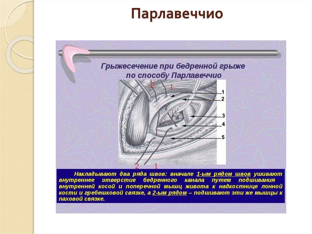 Бедренный способ. Руджи Парлавеччио пластика. Бедренная грыжа способ Бассини. Операция Руджи Парлавеччио. Бедренная грыжа Руджи Парлавеччио.