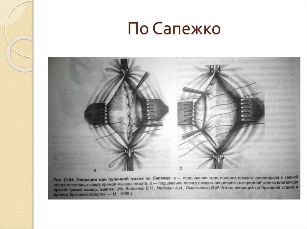 Пластика по сапежко