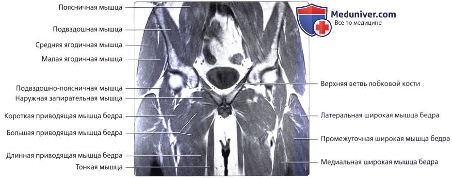 Мышцы таза мрт анатомия. Внутренняя запирательная мышца таза кт. Мышцы голени на кт. Ягодичные мышцы анатомия кт. Мышцы таза кт мрт анатомия.