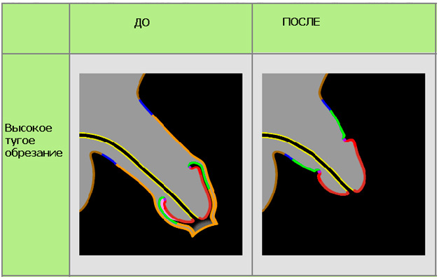 Почему обрезает. Обрезание у мужчин схема. Высокое тугое обрезание. Низкое тугое обрезание. Член до и после обрезания.