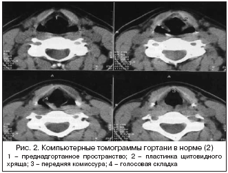 Кт гортани