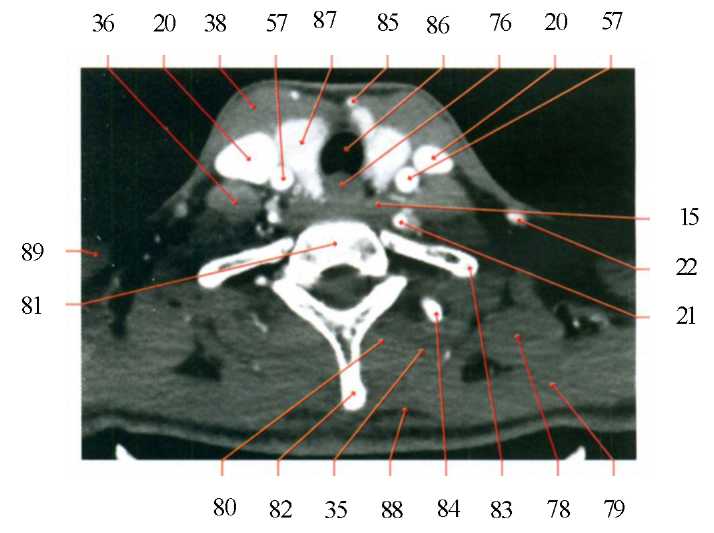 Кт анатомия. Мышцы шеи кт анатомия. Мягкие ткани шеи кт анатомия. Сосуды шеи кт анатомия. Кт анатомия мышц головы.