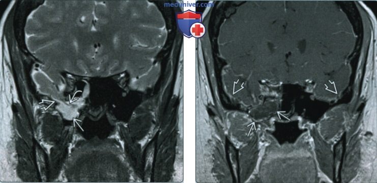 Мрт головного мозга т2. Электронные расцепители мрт7. Т1 ви на мрт. Т1 и т2 взвешенные изображения в мрт. Режимы мрт.