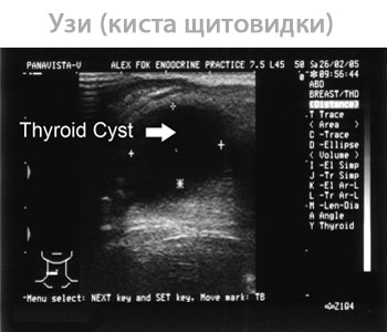 Как выглядит киста щитовидной железы на узи у женщин фото