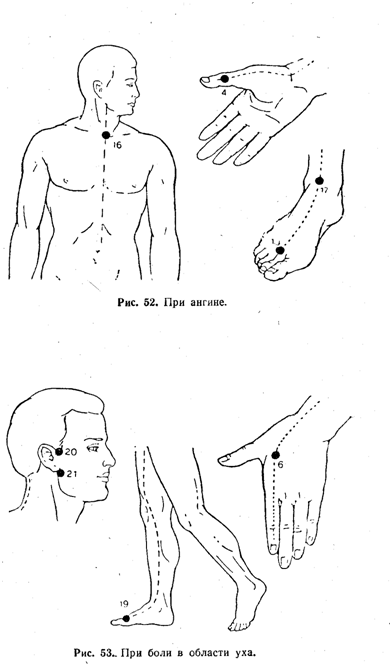 Эффективные точки. Акупрессура точки при бронхите. Рефлексотерапия точки воздействия при боли. Акупунктурные точки при ангине. Акупунктура при боли точки.