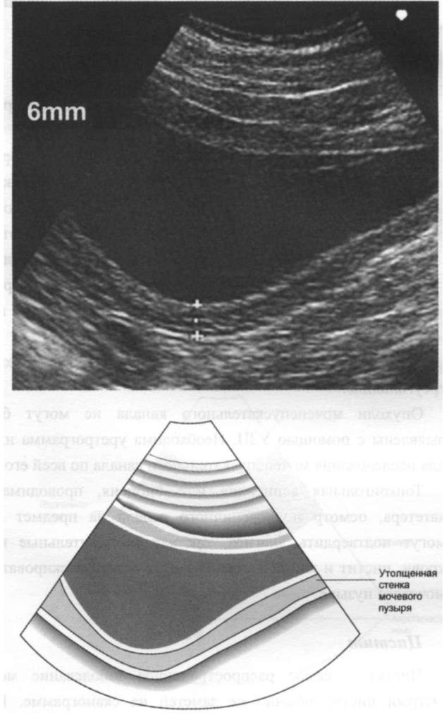 Утолщение стенки мочевого