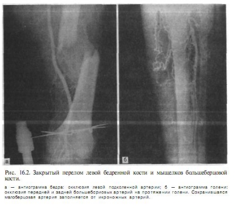 Окклюзия бедренной. Повреждение подколенной артерии симптомы. Бедренная артерия рентген. Травма бедренной артерии. Разрыв бедренной артерии.