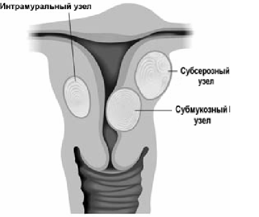 Миома матки субсерозна. Миома матки узлы классификация. Интрамуральный миоматозный узел что это. Субсерозная узел миома матки. Интрамуральный миоматозный узел что это.