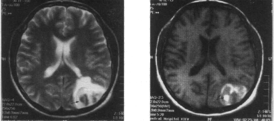 Синдром ишемии мозга. Ишемический инсульт мрт. Ишемический ОНМК на кт. Ишемический инсульт снимок кт. Ишемический инсульт головного мозга мрт.
