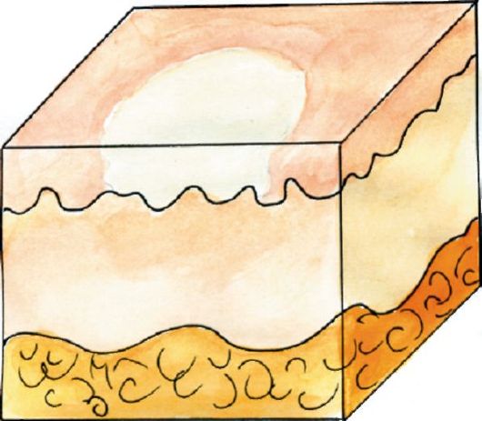 Пятно элемент сыпи. Эрозия вторичный морфологический элемент. Вторичные морфологические элементы кожи эрозия. Эрозия морфологический элемент. Первичные морфологические элементы кожи пятно.