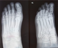 Перелом фаланги 5 пальца стопы рентген. Оскольчатый перелом пальца ноги рентген. Сколько заживает перелом пальца на ноге большого. Перелом фаланги большого пальца на ноге рентген. Перелом мизинца рентген.