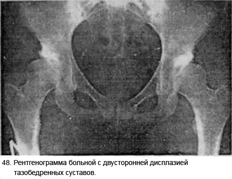 Склероз тазобедренного сустава что это. Вертлужная впадина субхондральный остеосклероз. Субхондральный склероз вертлужной впадины. Вертлужная впадина склерозирована. Субхондральный склероз локтевой кости.