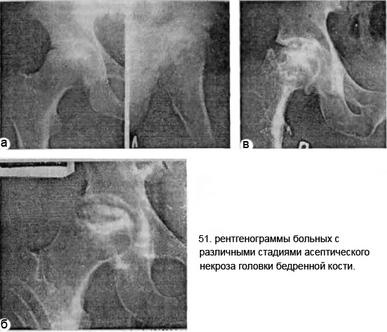 Некроз головки бедренной кости рентген