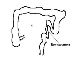 Долихосигма кишечника что это такое. Долихосигма толстой кишки. Толстый кишечник долихосигма. Долихосигма кишечника схема. Что такое долихосигма Толстого кишечника.