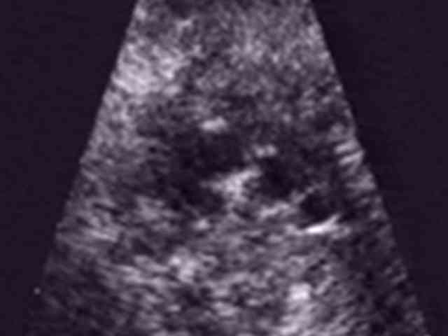 срез через 3. срез через 3 сосуда у плода. срез через 3. срез через 3. транспозиция магистральных сосудов эхокг.