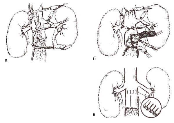 Тромбоз почечной артерии. Тромбоз нижней полой вены на кт. Тромбоз воротной вены на кт. Тромбоз почечных вен кт. Тромбоз портальной вены кт.