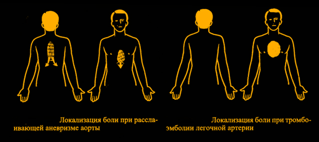 Болит солнечное сплетение причины. Болит солнечное сплетение. Боль в грудной клетке солнечное сплетение. Ноющая боль в области солнечного сплетения.