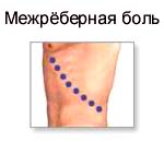 Сколько может болеть межреберная невралгия