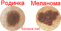 Меланома статистика