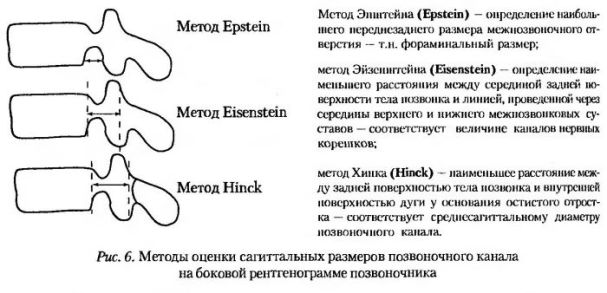 методы оценки сагиттальных размеров позвоночного канала