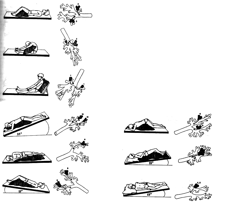 Постуральный дренаж. Позиционный дренаж при бронхоэктатической болезни. Постуральный дренаж бронхов. Постуральный дренаж алгоритм. Постуральный дренаж ЛФК.