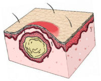 Воспаление ткани латынь