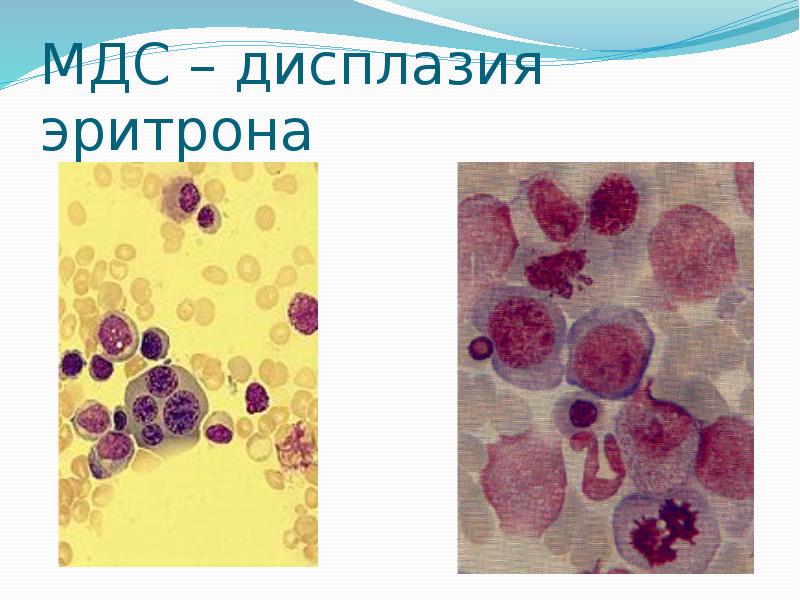 Эритрон. Система эритрона. Эритрон строение. Периферическая цитопения.