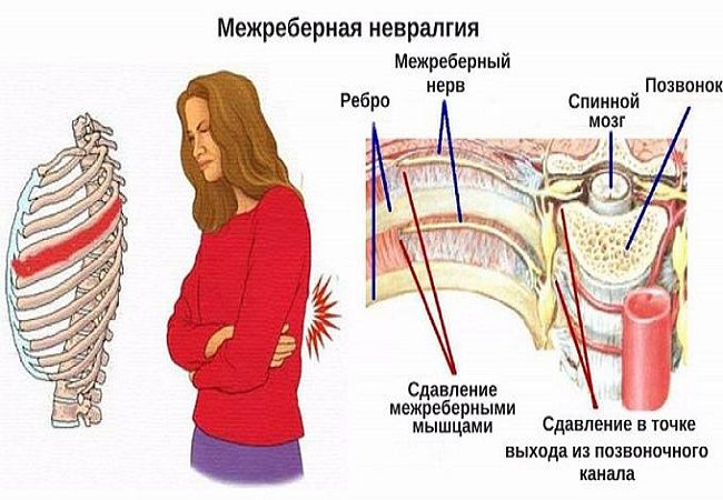 Боль при вдохе при невралгии. Боль при вдохе при невралгии