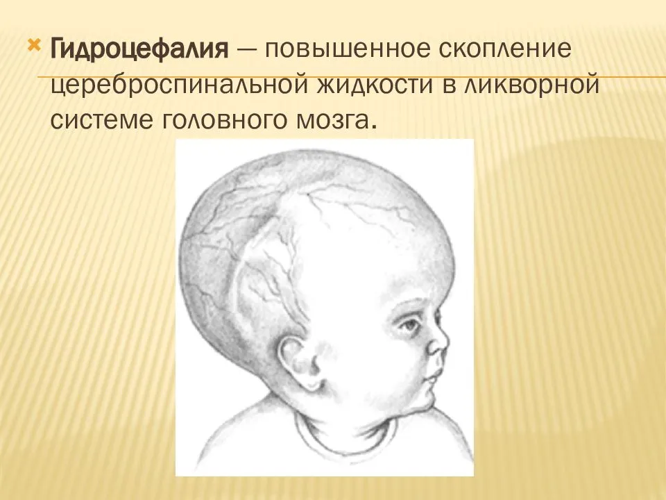 Гидроцефалия головного мозга что это. Гидроцефалия неврология. Тетравентрикулярная гидроцефалия. Компенсаторная гидроцефалия. Мультилокулярная гидроцефалия головного мозга.