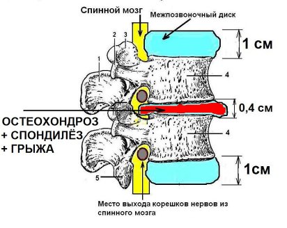 Высота межпозвоночного диска