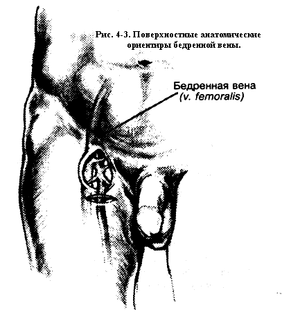 Укол в паховую вену схема описание